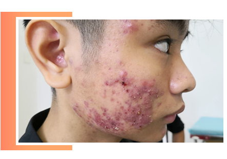 TÌM HIỀU VỀ BỆNH viêm da