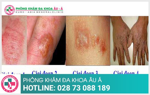 4 giai đoạn của bệnh chàm mà ai cũng nên biết - Phòng Khám Đa Khoa Âu Á
