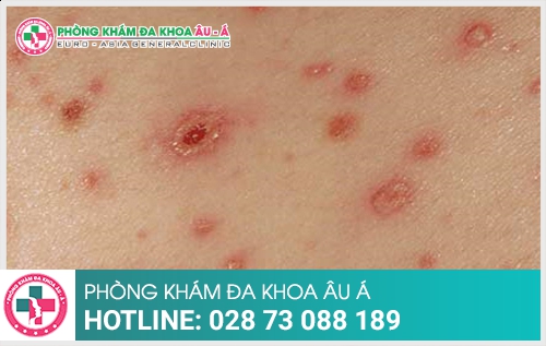 5 triệu chứng thường gặp  của bệnh ngứa da - Phòng Khám Đa Khoa Âu Á 