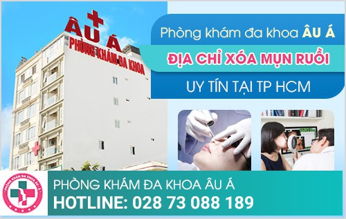 xóa nốt ruồi bằng laser