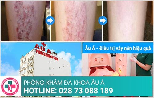 Địa chỉ điều trị vảy nến an toàn, hiệu quả