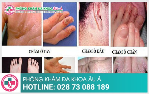 Bạn biết được bao nhiêu phần trăm về bệnh chàm? - Phòng Khám Đa Khoa Âu Á 