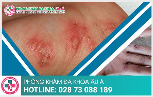 Bạn đã biết gì về bệnh ghẻ - Phòng Khám Đa Khoa Âu Á