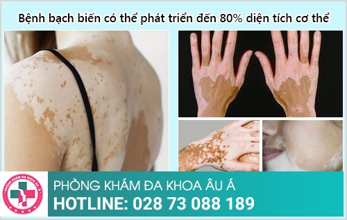 Bệnh bạch biến có chữa được không?