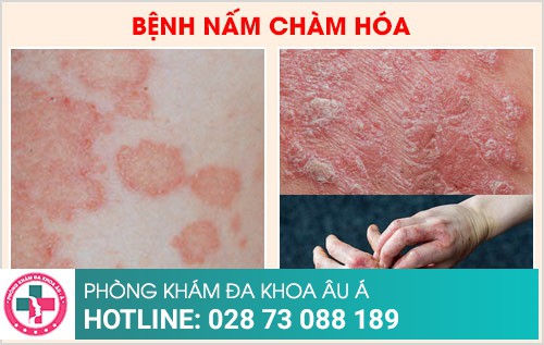 nấm chàm hóa