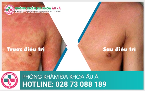Bệnh chàm và cách điều trị hiệu quả 