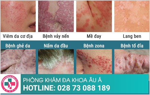 bệnh viện da liễu hcm