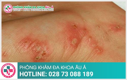 Bệnh ghẻ có nguy hiểm không bác sĩ ơi - Phòng Khám Đa Khoa Âu Á