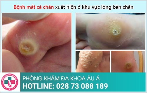 điều trị bệnh mắt cá chân