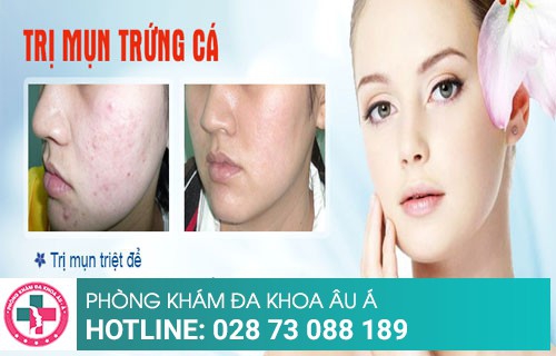 Bệnh viện da liễu trị mụn an toàn, chất lượng