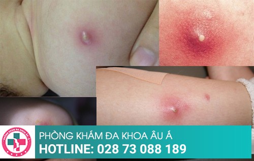 Bị mụn nhọt dùng thuốc điều trị có hiệu quả không?