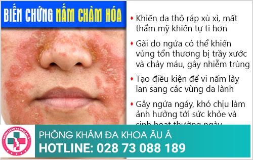 bệnh chàm hóa