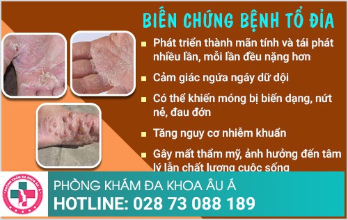 bệnh tổ đỉa