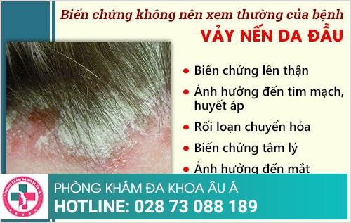 vảy nến da đầu