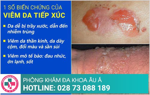 điều trị viêm da tiếp xúc