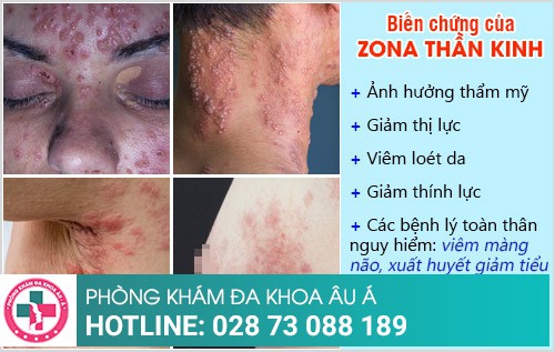 biến chứng zona thần kinh