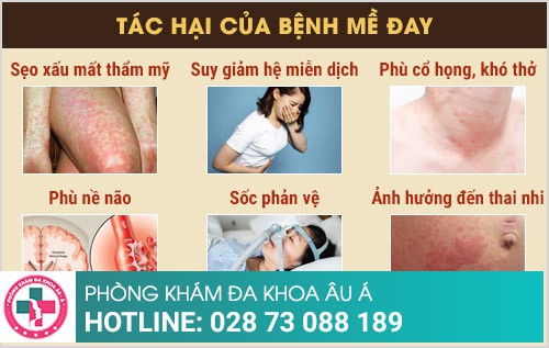 Cách trị nổi mề đay an toàn, hiệu quả