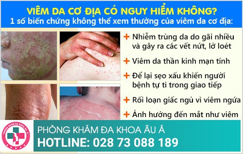 viêm da cơ địa có nguy hiểm không