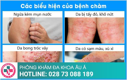 khám bệnh chàm ở đâu