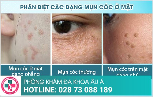 Mụn cóc ở mặt: Dấu hiệu và cách điều trị