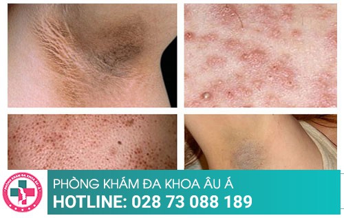 Các phương pháp trị viêm nang lông hiện đại