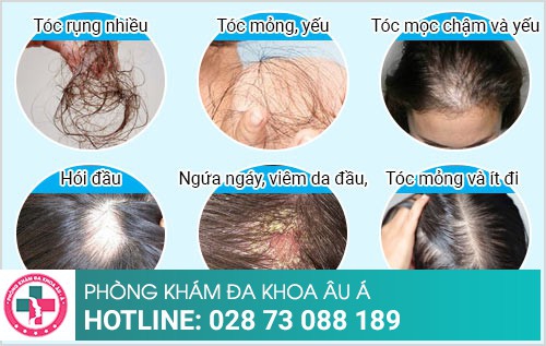 phòng khám điều trị rụng tóc