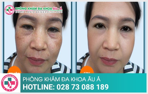 Cách hỗ trợ điều trị đốm màu hiệu quả  hiện nay