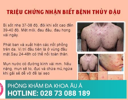 Cách chữa trị bệnh thủy đậu hiệu quả, ngăn ngừa sẹo