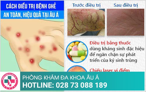 cách trị bệnh ghẻ