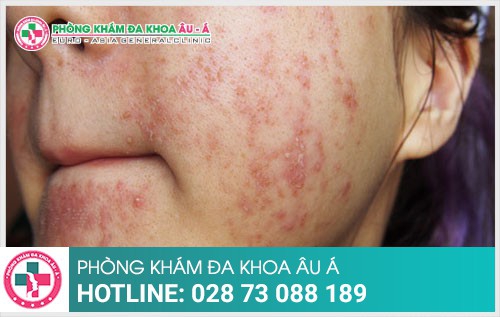 Cách trị dị ứng da mặt an toàn – hiệu quả hiện nay
