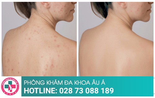Cách trị mụn bằng những phương pháp tiên tiến