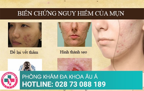 Cách trị mụn bằng những phương pháp tiên tiến