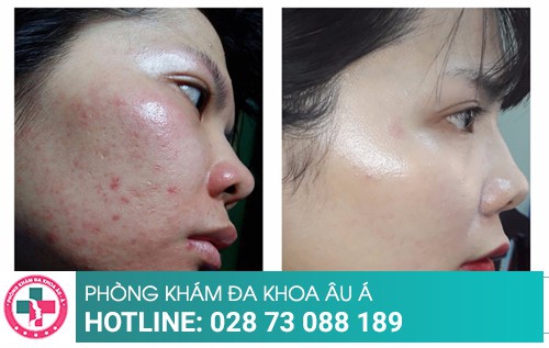 Cách trị mụn bằng những phương pháp tiên tiến