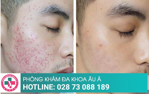 Cách trị mụn bằng những phương pháp tiên tiến