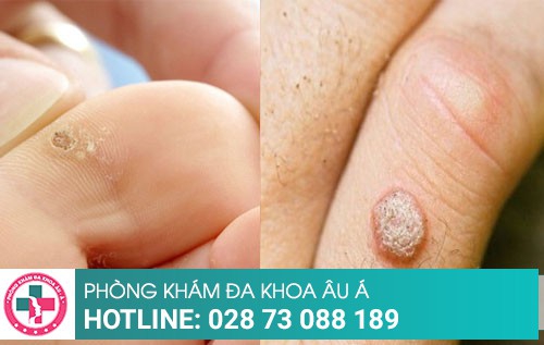 Cách trị mụn cóc tại Phòng Khám Da Liễu Âu Á