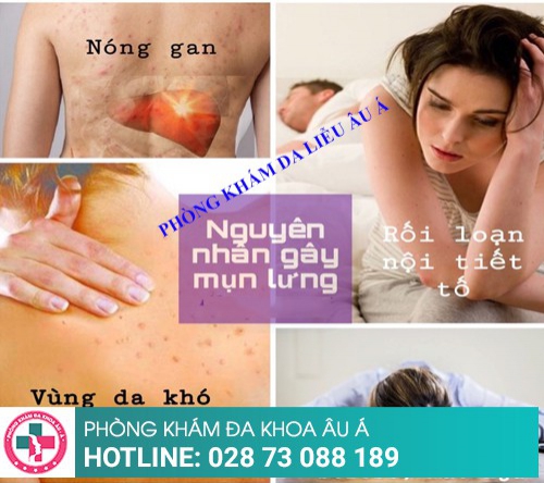 Cách trị mụn lưng đơn giản, đạt hiệu quả cao