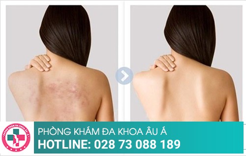 Cách trị mụn lưng đơn giản, đạt hiệu quả cao