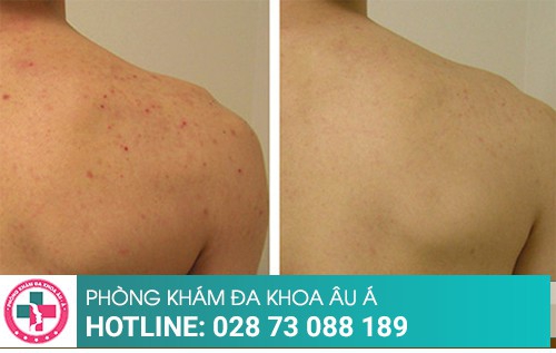 Cách trị mụn lưng đơn giản, đạt hiệu quả cao