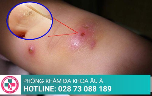 Cách trị mụn ở chân nhanh chóng, không để lại sẹo