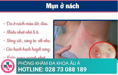 Cách trị mụn ở nách hiệu quả và không đau