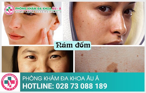 Cách trị nám da hiệu quả, an toàn
