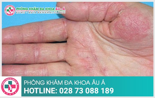 Cách trị nấm da tay hiệu quả và an toàn