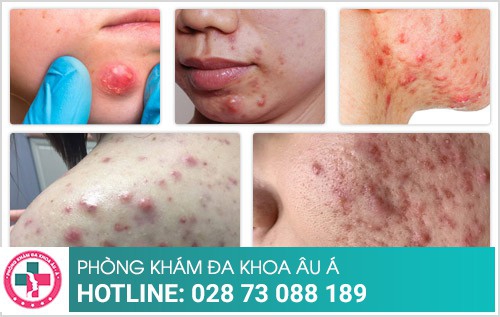 Khám mụn nhọt ở đâu tốt nhất tại TP.HCM?