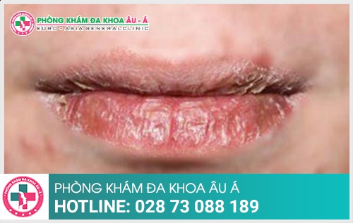 Chàm môi và cách hỗ trợ điều trị trị hiệu quả  hiện nay - Phòng Khám Đa Khoa Âu Á 