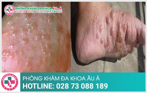 Chàm tổ đỉa nguyên nhân và cách chấm dứt bệnh - Phòng Khám Đa Khoa Âu Á