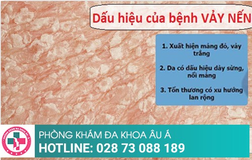 Chi phí điều trị vảy nến năm 2019 là bao nhiêu?