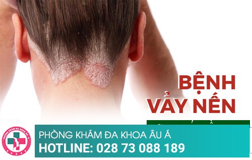 Chi phí điều trị vảy nến năm 2019 là bao nhiêu?