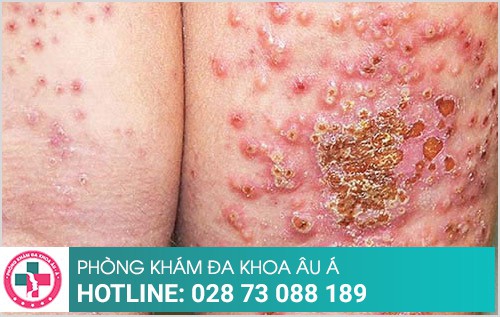 bệnh chàm khô