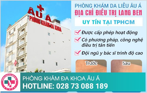 cách trị lang ben hiệu quả