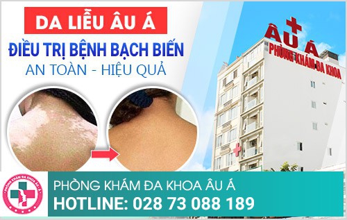 Bệnh bạch biến có chữa được không?